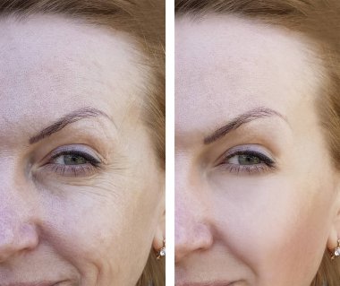 Yaşlı bir kadın yüzü kırışıklıklar daha önce ve sonra