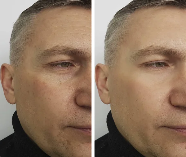Άνθρωπος Πρόσωπο Ρυτίδες Πριν Και Μετά — Φωτογραφία Αρχείου