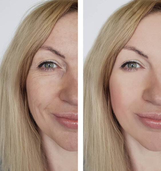 face girl wrinkle before and after cosmetic procedures