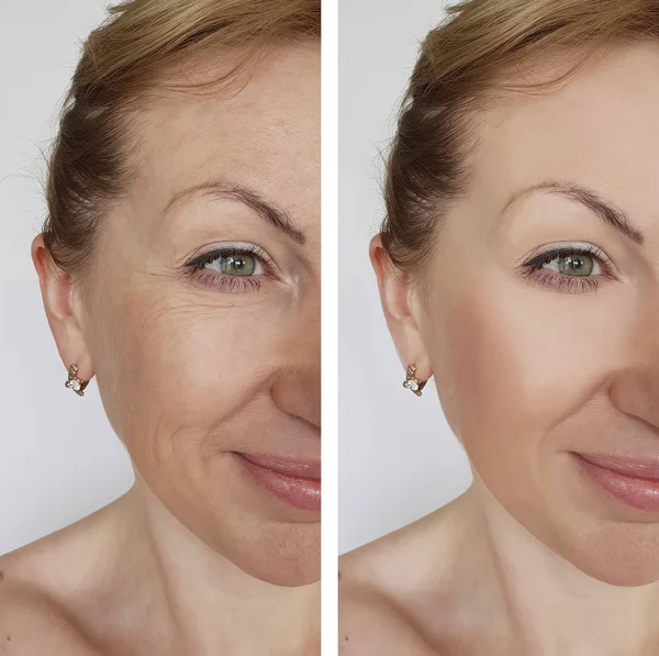 Face Girl Wrinkle Cosmetic Procedures — Stock Photo, Image