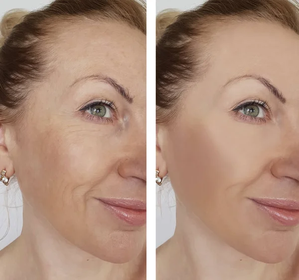 面部女孩皱纹前和后化妆程序 — 图库照片