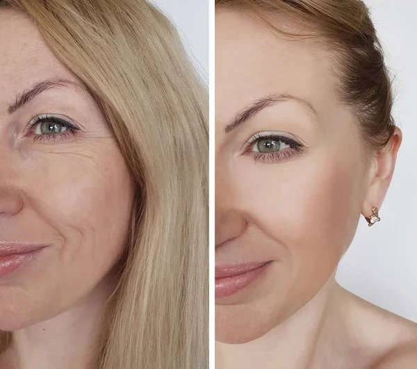 Falten Gesicht Vor Und Nach Kosmetischen Eingriffen — Stockfoto