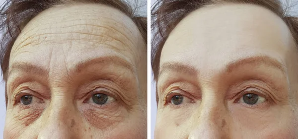 Stirnfalten Bei Älteren Frauen Vor Und Nach Kosmetischen Eingriffen — Stockfoto