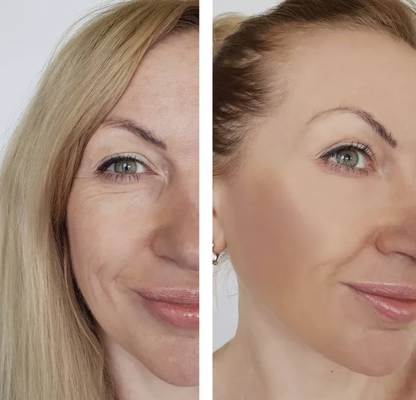 Wanita Wajah Keriput Sebelum Dan Setelah Prosedur Kosmetik — Stok Foto