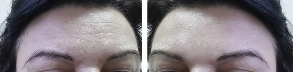 Cara Mujer Frente Arrugas Antes Después Los Procedimientos Cosméticos — Foto de Stock