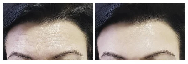 Stirn Der Frau Vor Und Nach Eingriffen — Stockfoto