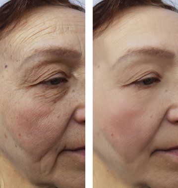 Yaşlı bir kadın yüzü kırışıklıklar daha önce ve sonra yordamları