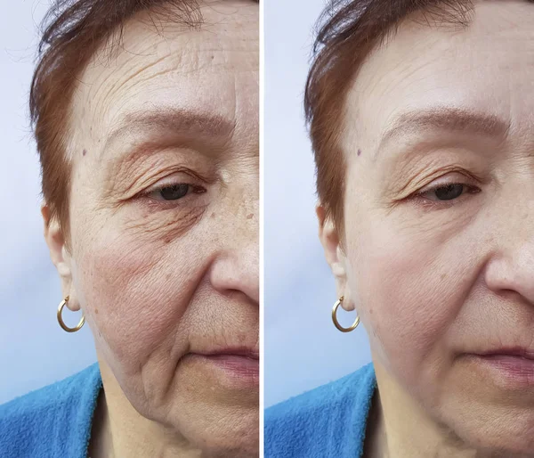 面对老年妇女的皱纹前后的程序 — 图库照片