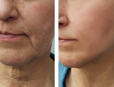 Yaşlı bir kadın yüzü kırışıklıklar daha önce ve sonra yordamları