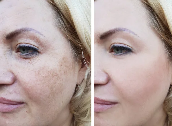 Kız Yüz Kırışıklıklar Öncesi Sonrası Pigmentasyon — Stok fotoğraf