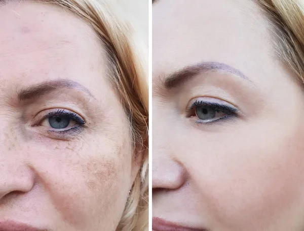 Girl Face Wrinkles Pigmentation — Stock Photo, Image
