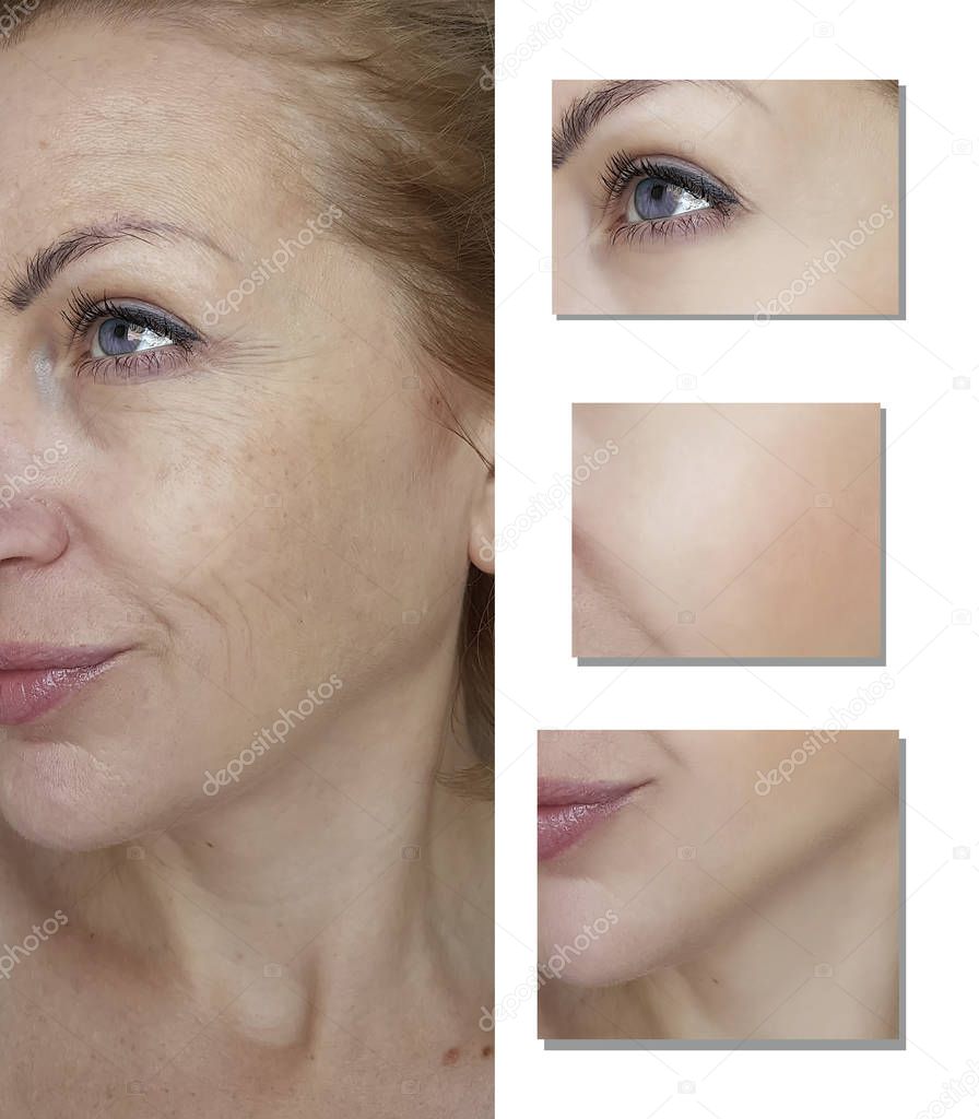 face woman wrinkles before and after procedures