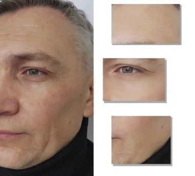 yüz adam kırışıklıklar öncesi ve sonrası yordamları