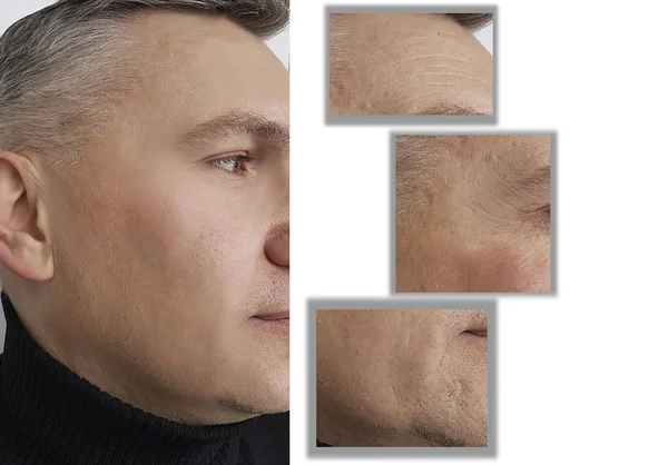 Falten Gesicht Des Mannes Vor Und Nach Eingriffen — Stockfoto