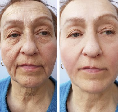 Yaşlı bir kadının yüz önce ve sonra prosedürler yüz kırışıklıkları