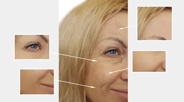 女性シワ顔の前に と後の手順 — ストック写真