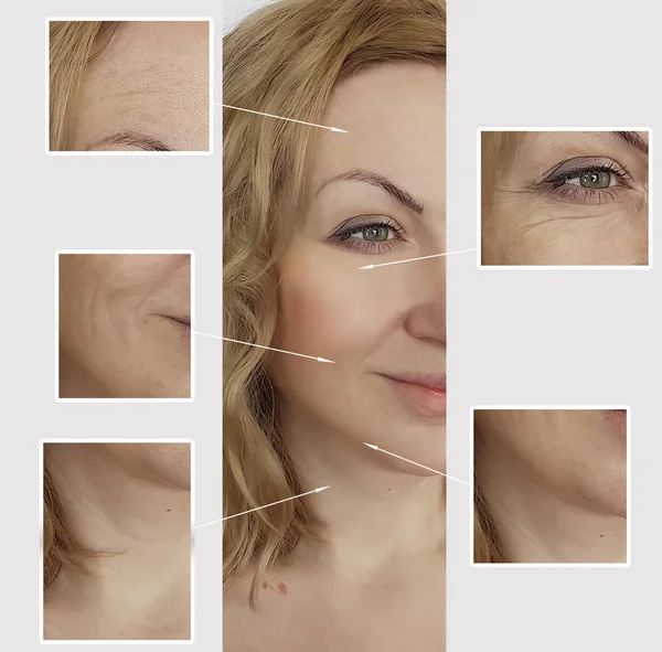 woman wrinkles face before and after procedures