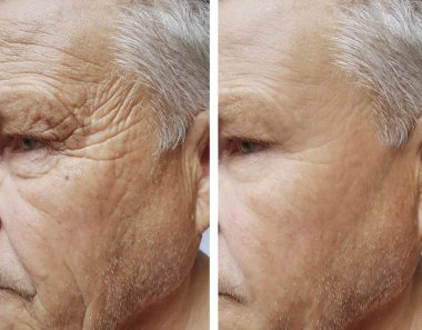 Yaşlı bir adamın yüzünü yüz kırışıklıklar daha önce ve sonra yordamları