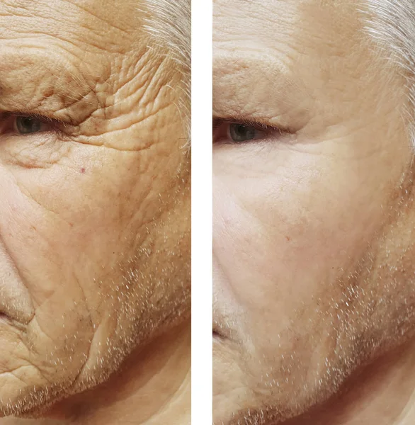 Πρόσωπό Του Ένα Ηλικιωμένο Άτομο Ρυτίδες Προσώπου Πριν Και Μετά — Φωτογραφία Αρχείου