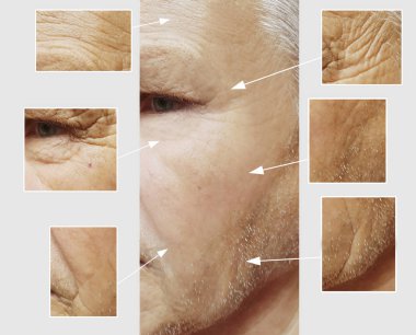face of an elderly man wrinkles face before and after procedures clipart