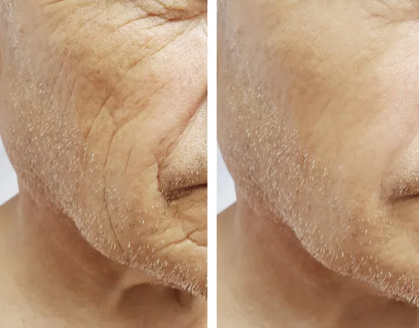 老人の顔のしわ顔の前に と後の手順 — ストック写真