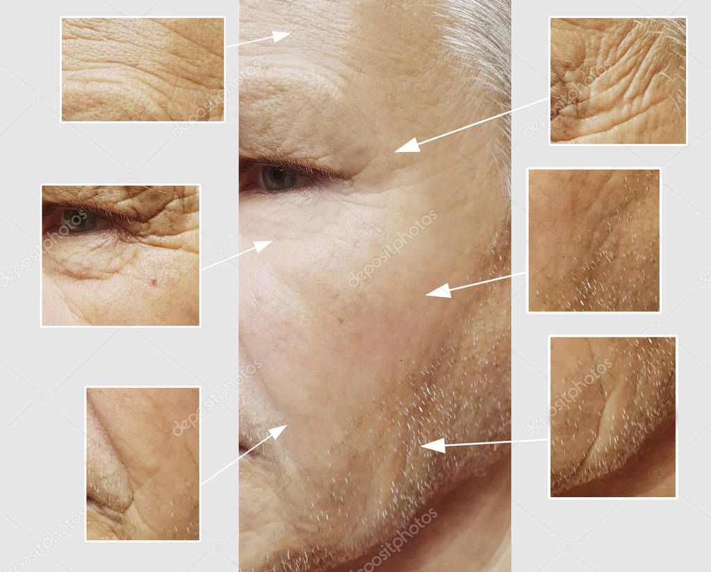 face of an elderly man wrinkles face before and after procedures