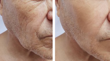 Yaşlı bir adamın yüzünü yüz kırışıklıklar daha önce ve sonra yordamları