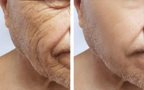 Man Old Wrinkles Face Procedures — Stok Foto