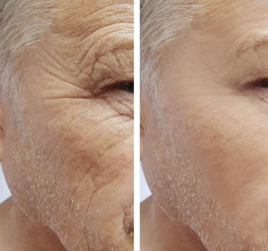 old man, wrinkles on face before and after procedures