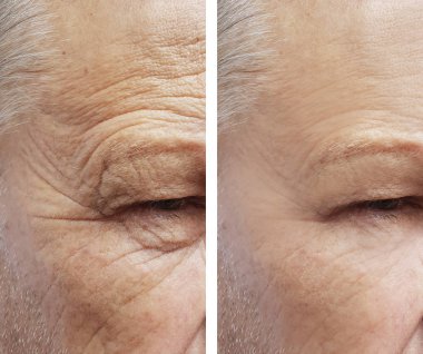 old man, wrinkles on face before and after procedures