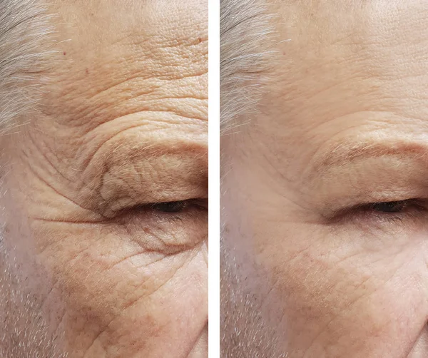 Old Man Wrinkles Face Procedures — Stok fotoğraf