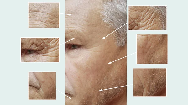 Old Man Wrinkles Face Procedures — Stok fotoğraf