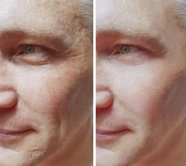 Άνθρωπος Ρυτίδες Πριν Και Μετά Από Διαδικασίες — Φωτογραφία Αρχείου