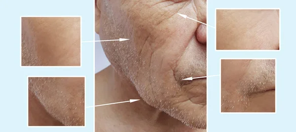 Άνθρωπος Ηλικιωμένους Πρόσωπο Ρυτίδες Πριν Και Μετά Από Διαδικασίες — Φωτογραφία Αρχείου