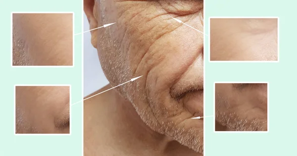 man elderly face wrinkles before and after procedures