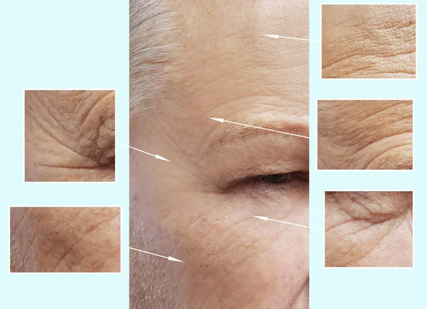 Mann Ältere Gesichter Falten Vor Und Nach Eingriffen — Stockfoto