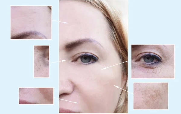 Wanita Wajah Keriput Sebelum Dan Setelah Prosedur Pigmentasi — Stok Foto