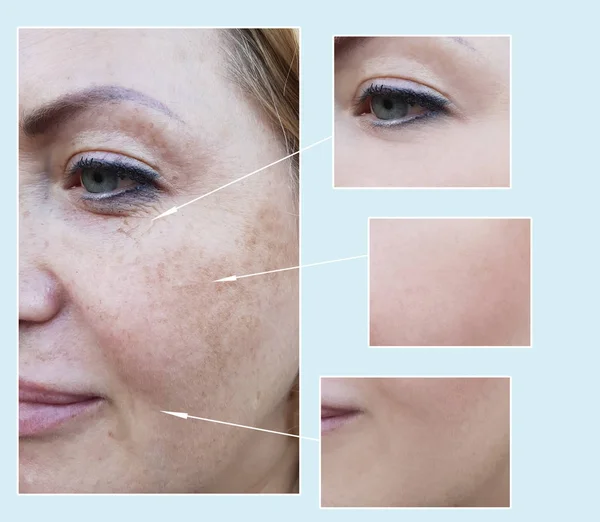 Falten Gesicht Der Frau Vor Und Nach Eingriffen Pigmentierung — Stockfoto