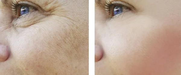 Visage Femme Rides Yeux Avant Après Les Procédures Pigmentation — Photo