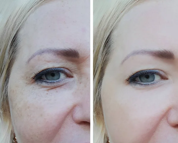 Wanita Wajah Keriput Sebelum Dan Setelah Pigmentasi — Stok Foto