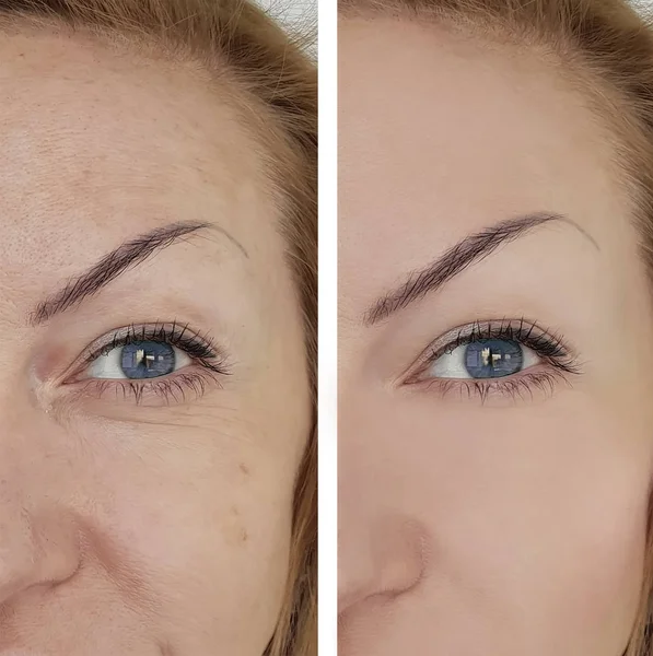 Wanita Wajah Keriput Sebelum Dan Setelah Pigmentasi — Stok Foto