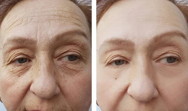 Ρυτίδες Προσώπου Από Μια Ηλικιωμένη Γυναίκα Πριν Και Μετά Από — Φωτογραφία Αρχείου