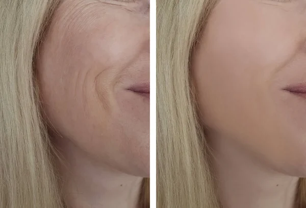 woman wrinkles face before and after cosmetic procedures