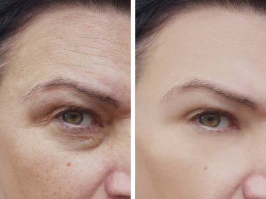 kırışıklıkları yüz kadın öncesi ve sonrası yordamları, pigmentasyon