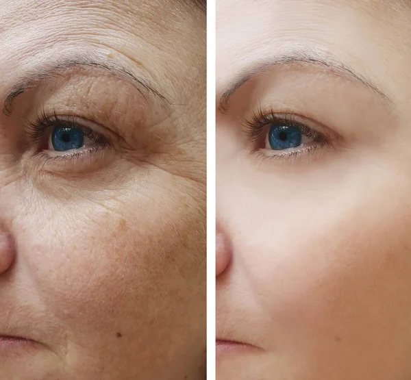 Falten Gesicht Frau Vor Und Nach Eingriffen Pigmentierung — Stockfoto