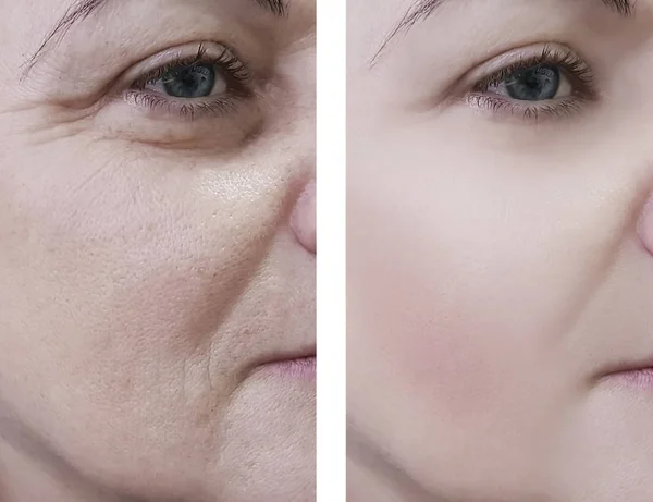 Arrugas Mujer Cara Antes Después Los Procedimientos Cosméticos — Foto de Stock