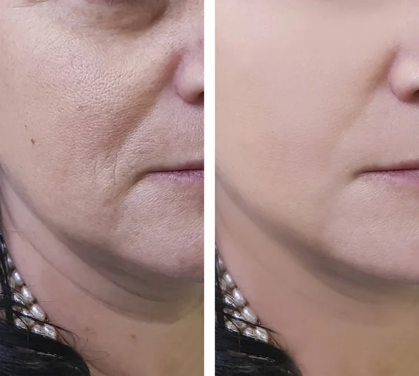 Wanita Keriput Wajah Sebelum Dan Setelah Prosedur Kosmetik — Stok Foto