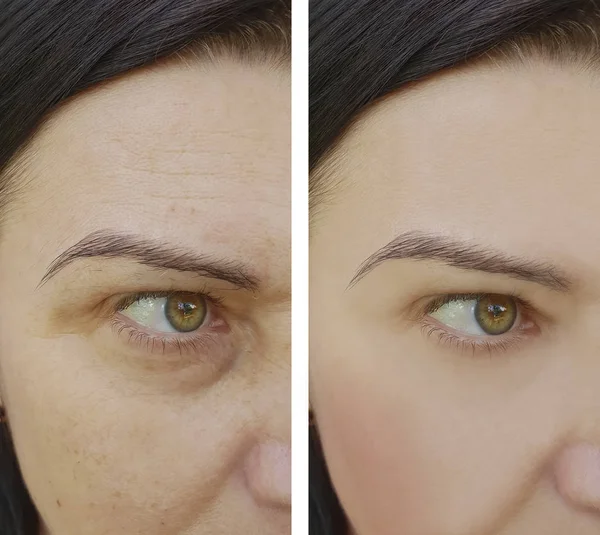 Arrugas Mujer Cara Antes Después Los Procedimientos Cosméticos — Foto de Stock