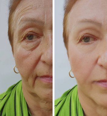Yaşlı kadın kırışıklıkları yüz öncesi ve sonrası yordamları