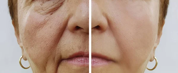 Wanita Tua Keriput Wajah Sebelum Dan Setelah Prosedur — Stok Foto
